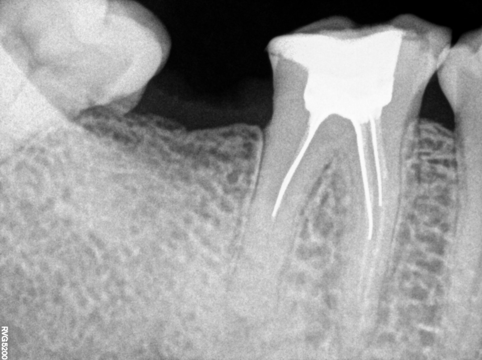 Dental X-ray